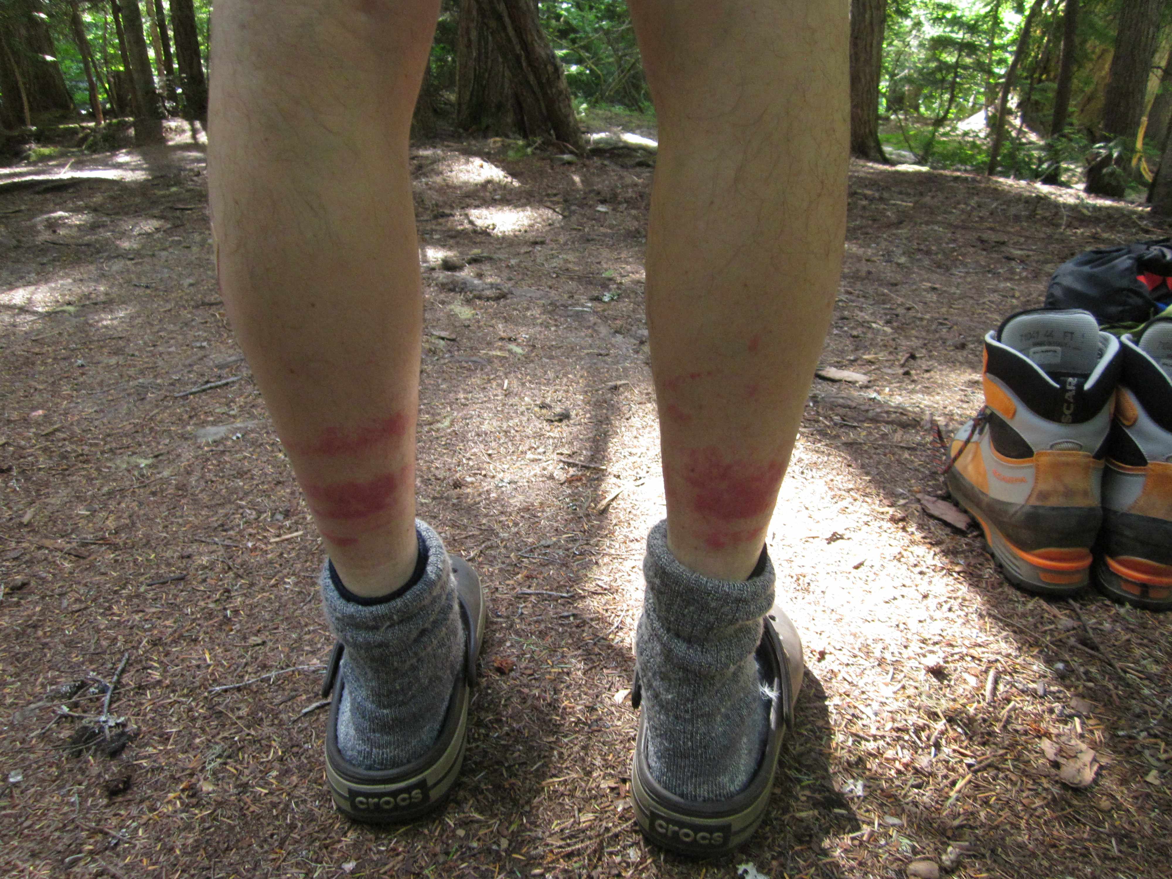 Rash On Legs After Hiking At Marianne Holt Blog